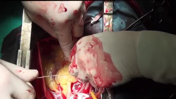 Cirugía del corazón profesional médico manos único macro video en la clínica . — Vídeos de Stock