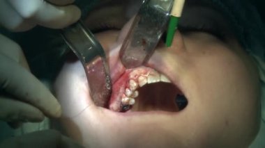 Cerrahlar modern ofis kliniğindeki bir hastanın diş dolgularını modern diş teçhizatı ve anestezi kullanarak çıkarırlar. Kapalı diş bakımı oral ve maksimum yüz implantı ameliyatı.