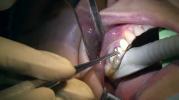 Estomatologista fazer a remoção de dentes um paciente em sala de cirurgia clínica escritório moderno usa equipamentos odontológicos modernos e anestesia. Cuidados dentários de perto cirurgia de implante bucomaxilofacial e oral. — Vídeo de Stock