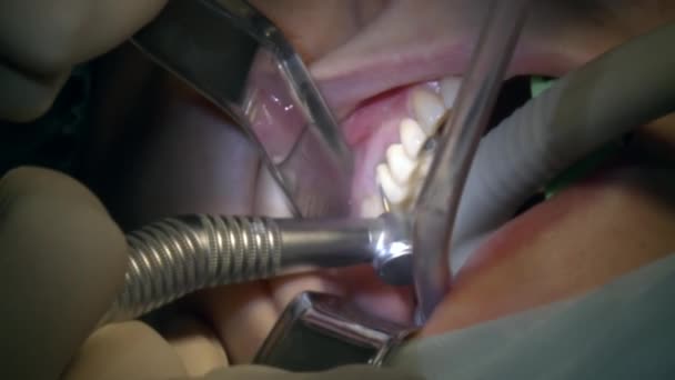 口腔科医生在现代办公室诊所手术室里安装假牙时，使用的是现代牙科设备和麻醉设备。口腔和颌面部植入手术的特写牙科护理. — 图库视频影像
