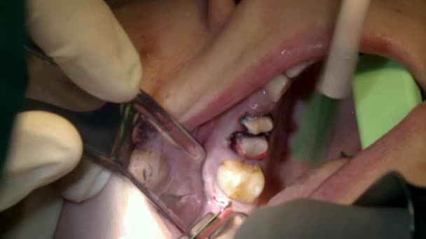 Stomatoloog extract tand in mond in tandheelkundige kliniek, close-up — Stockvideo