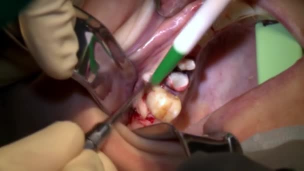 Dentist do removal of caries on teeth a patient in modern office clinic operating room uses modern dental equipment and anesthesia. Close-up dental care oral and maxillofacial implant surgery. — Stock Video