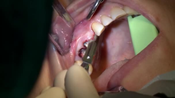 Dentysta usuwa krew, a pacjent na nowoczesnej sali operacyjnej gabinetu korzysta z nowoczesnego sprzętu stomatologicznego i znieczulenia. Zbliżenie opieki stomatologicznej implanty jamy ustnej i szczękowo-twarzowej. — Wideo stockowe