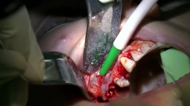Cerrahlar, modern ofis kliniğindeki bir hastanın dişlerini delmek için modern diş ekipmanı ve anestezi kullanır. Kapalı diş bakımı oral ve maksimum yüz implantı ameliyatı. — Stok video