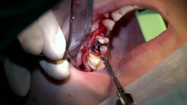 Medico professionista fare denti lucidatura un paziente in ambulatorio ambulatoriale moderna sala operatoria utilizza moderne attrezzature dentali e anestesia. Primi piani di chirurgia dentale orale e maxillo-facciale . — Video Stock