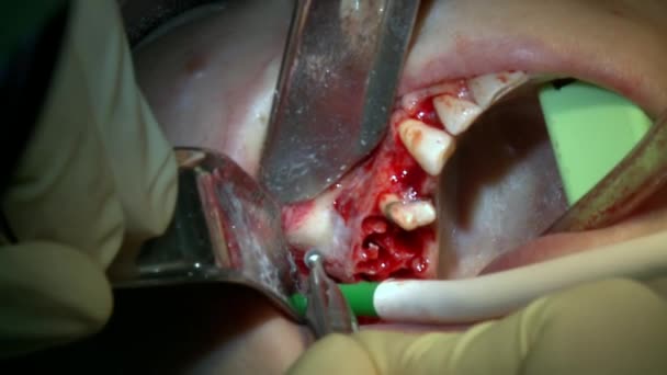 牙科医生在现代化的办公室诊所手术室里用现代化的牙科设备和麻醉设备对病人进行牙科检查。 口腔和颌面部植入手术的特写牙科护理. — 图库视频影像