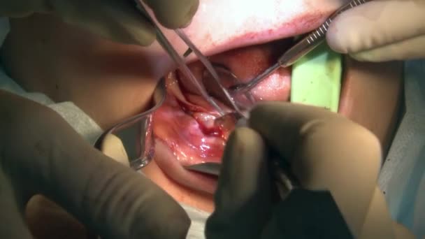 Chirurg doen polijsten tand een patiënt in moderne kantoor kliniek operatiekamer maakt gebruik van moderne tandheelkundige apparatuur en verdoving. Close-up mond- en maxillofaciale implantaatchirurgie. — Stockvideo