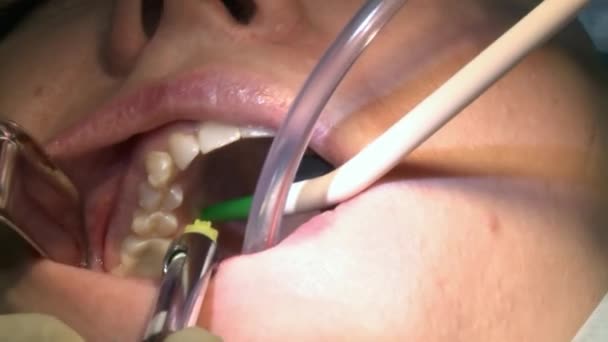 Chirurg doen tandheelkundige implantaat installatie een patiënt in moderne kantoor kliniek operatiekamer maakt gebruik van moderne tandheelkundige apparatuur en verdoving. Close-up mond- en maxillofaciale implantaatchirurgie. — Stockvideo
