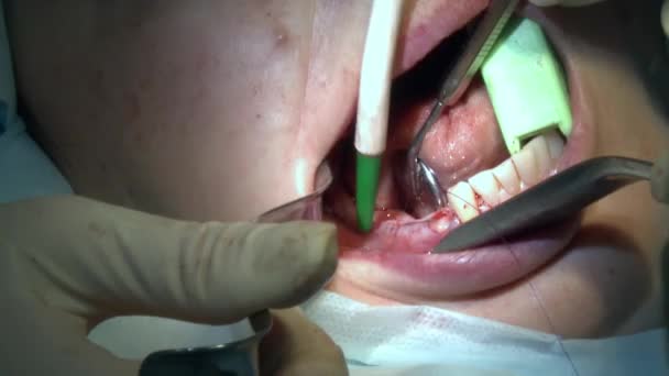 Stomatolog używa dziąseł wiertniczych, a pacjent w nowoczesnej sali operacyjnej gabinetu korzysta z nowoczesnego sprzętu stomatologicznego i znieczulenia. Zbliżenie opieki stomatologicznej implanty jamy ustnej i szczękowo-twarzowej. — Wideo stockowe