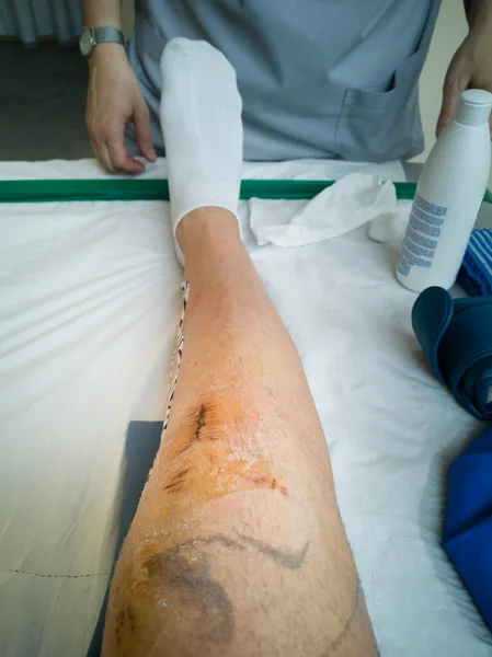 Lesão Joelho Após Remoção Dos Pontos Após Cirurgia Joelho — Fotografia de Stock