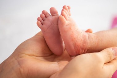 Kırmızı kuru derili bebek bacakları. Süt formülü ya da diğer yiyeceklere alerjisi var. Yakın çekim. Çekim.