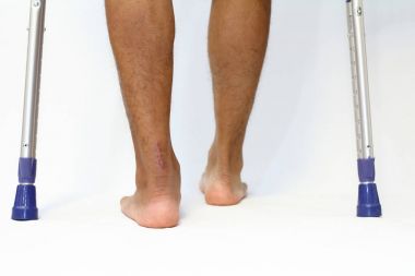 Achilles tendon yırtığı ve crutchs işlemi skar