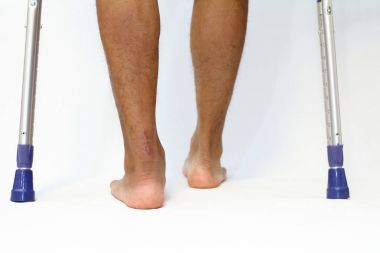 operation scar of Achilles tendon rupture and crutchs clipart