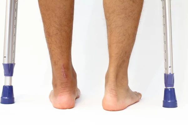 Művelet scar Achilles-ín szakadás és crutchs — Stock Fotó