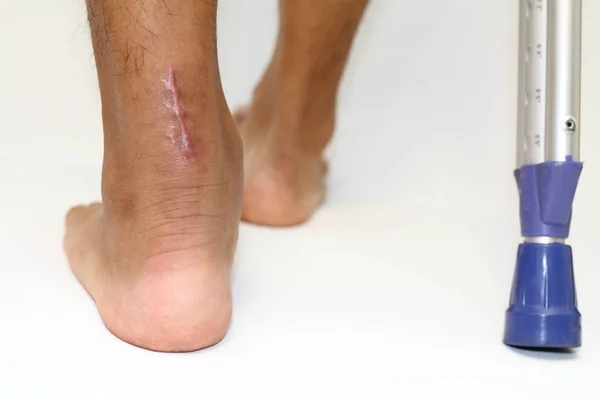 Achilles tendon yırtığı ve crutchs işlemi skar