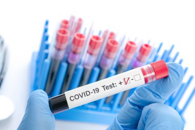 Coronavirus enfeksiyon konsepti - doktor elinde kan örneği tutuyor COVID - 19 pozitif test laboratuvarda