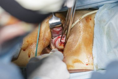 Rahim kaldırma ameliyatı