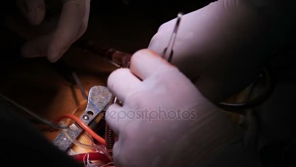 Cirurgiões cardíacos Trabalho em equipe em cirurgia cardíaca aberta Close-up — Vídeo de Stock