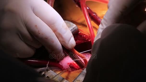 Le chirurgien attache les tubes à un cœur — Video