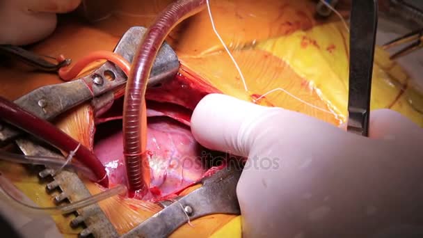 Detalle de cirugía a corazón abierto — Vídeos de Stock