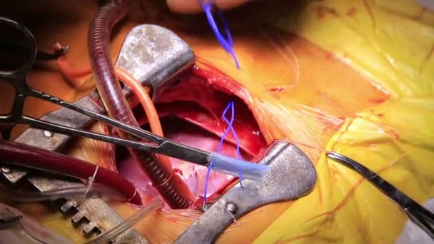 Hart verbonden met cardiopulmonale Bypass Closeup — Stockvideo
