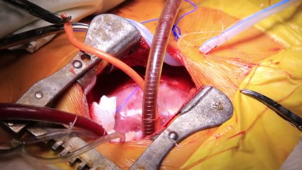 Otevřené srdce bije během operace