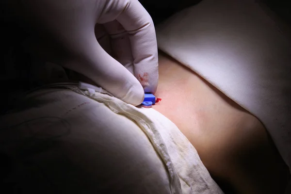 Merkezi Venöz kateter