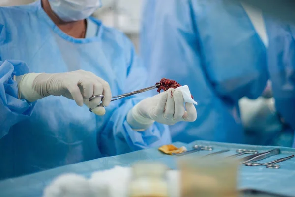 Pedazo de tumor —  Fotos de Stock