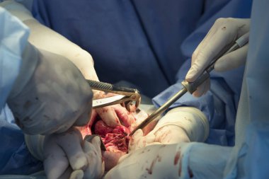 Forseps dişine kadar yakın