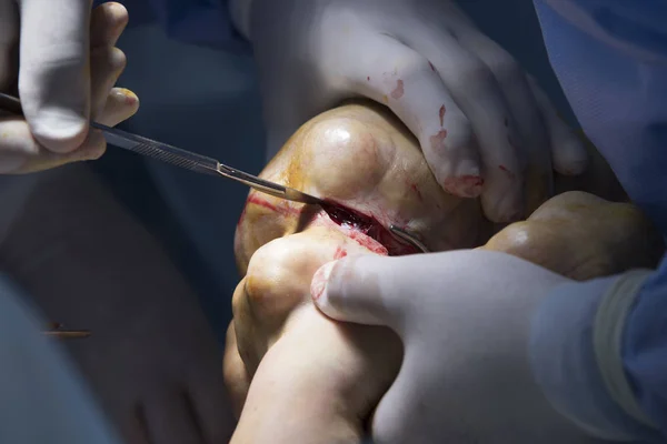 Hand Amputation Close Up — Stock Photo, Image