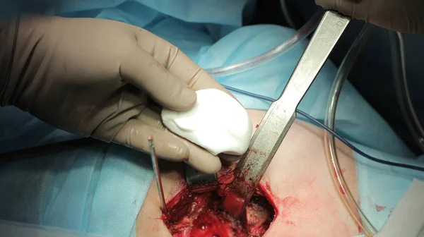 Цемент для хірургії кульшового суглоба — стокове фото