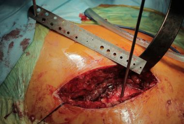 Cerrahi cetvel yakın çekim