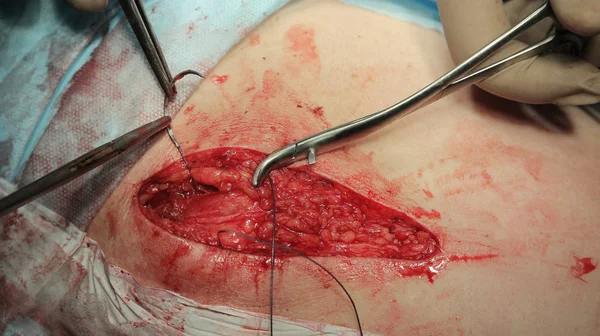 Хирургическая игла и используемая нитка — стоковое фото