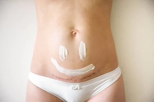 Primer plano del vientre de la mujer con una cicatriz de una cesárea y de crema cosmética en la piel — Foto de Stock