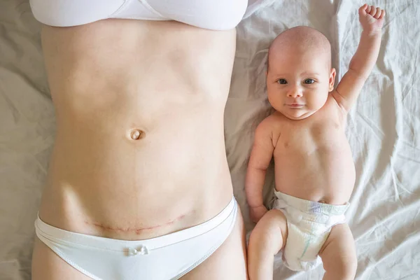 Nahaufnahme des Bauches einer Frau mit einer Narbe vom Kaiserschnitt und ihrem Baby in der Nähe — Stockfoto