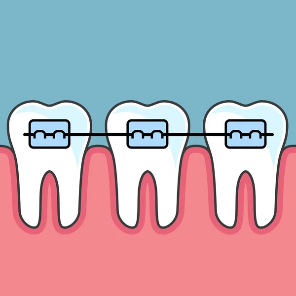 Dientes con frenos dentales - arreglos dentales — Vector de stock