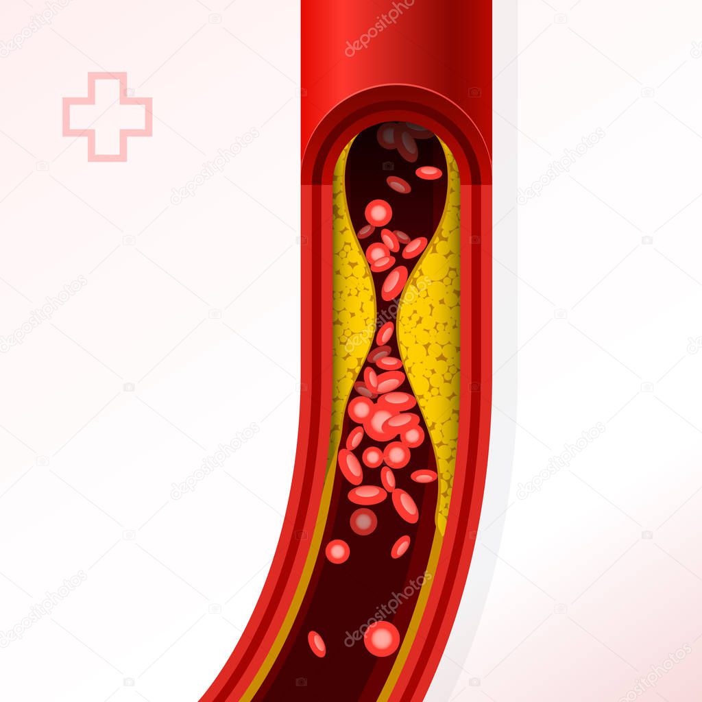 Artery section with cholesterol buildup - cholesterol and thromb