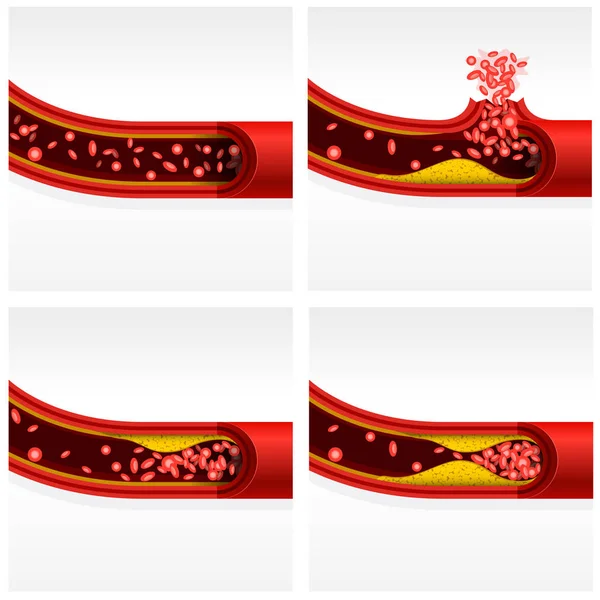 Coupe artérielle avec cholestérol et thrombose, accident vasculaire cérébral — Image vectorielle