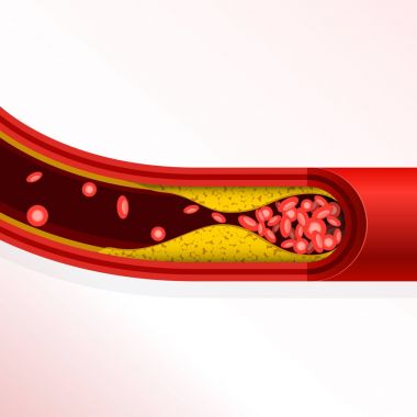 Thrombosis of artery - cholesterol buildup, arteriosclerosis  clipart