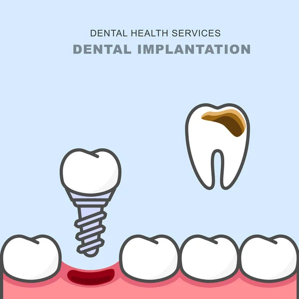 Implante dental en lugar de dientes cariosos: prótesis dentales — Vector de stock