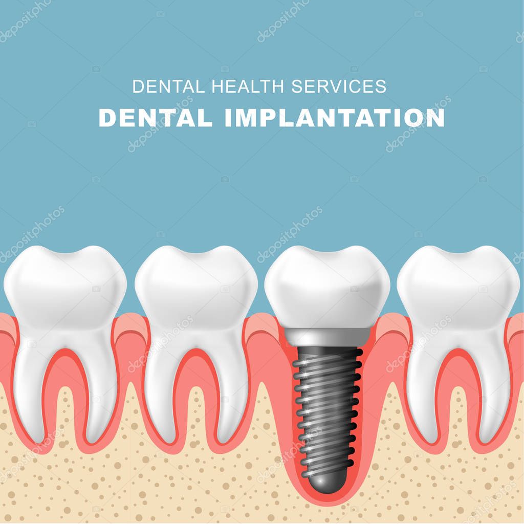 Dental implantation - row of teeth in gum with implant
