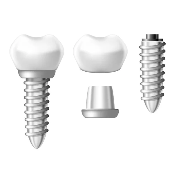 Dental implant onderdelen - tand gebit onderdelen — Stockvector