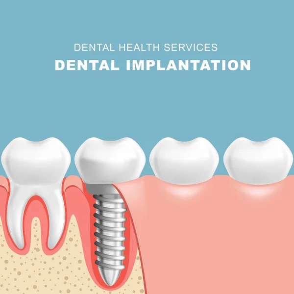 Žvýkačku Sekce Zubní Implantat Řada Zubů — Stockový vektor