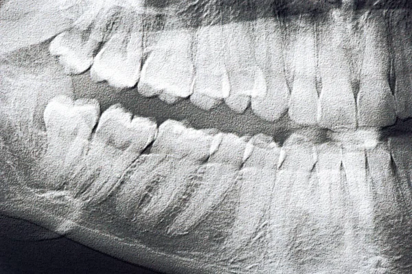 stock image Panoramic x-ray of the jaw of the man close up