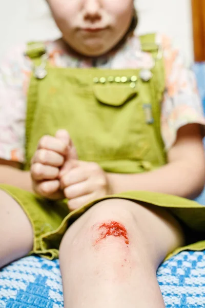 Kleines Mädchen verletzte sich am Knie — Stockfoto