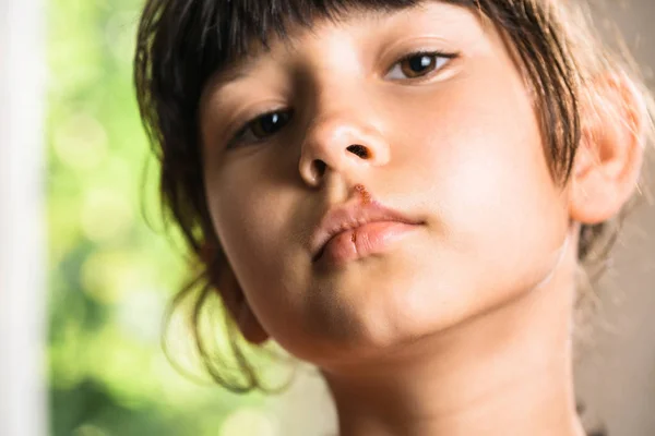 Herpes op bovenlip van klein meisje. Kind met koortsblaasjes op haar lippen. — Stockfoto