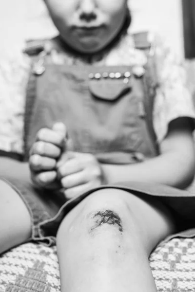 little girl hurt her knee.black and white.