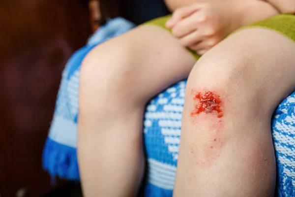 Kleines Mädchen verletzte sich am Knie — Stockfoto