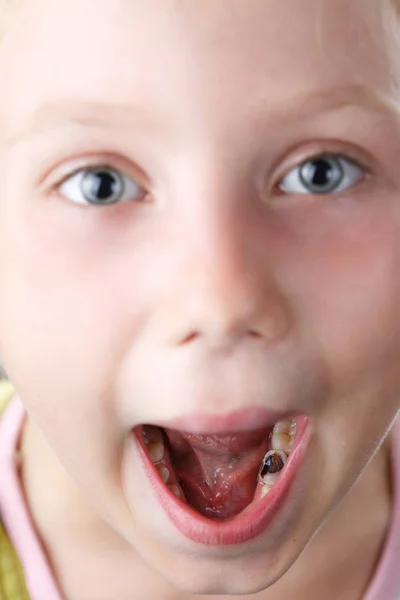 Little girl opens her mouth and shows sick tooth — Stock Photo, Image