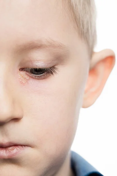 Enfermedad del herpes ocular infantil en una cara . —  Fotos de Stock